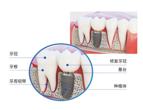 瑞士种植体SLA到底怎么样？四级纯钛材质，生物相容性好