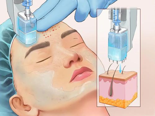 二、inmode钻石超塑疗程次数与疗效的关系