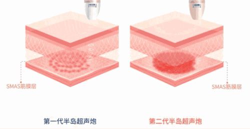 四、inmode钻石超塑疗效时间线与术后护理