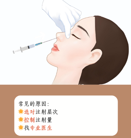 伊维兰注射隆鼻好吗？真实测评揭秘：安全有效又自然，2026年用户强烈推荐！