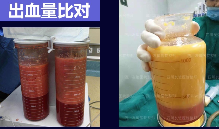 上半身抽脂几天才能不那么难受？术后第5天多数人已不那么难受！