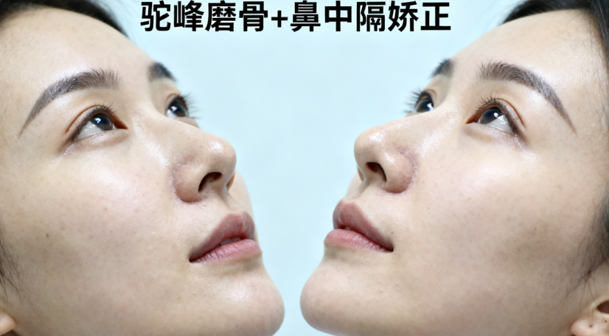 打鼻子极致和丰颜哪个好？医生推荐：丰颜维持6-8个月更自然