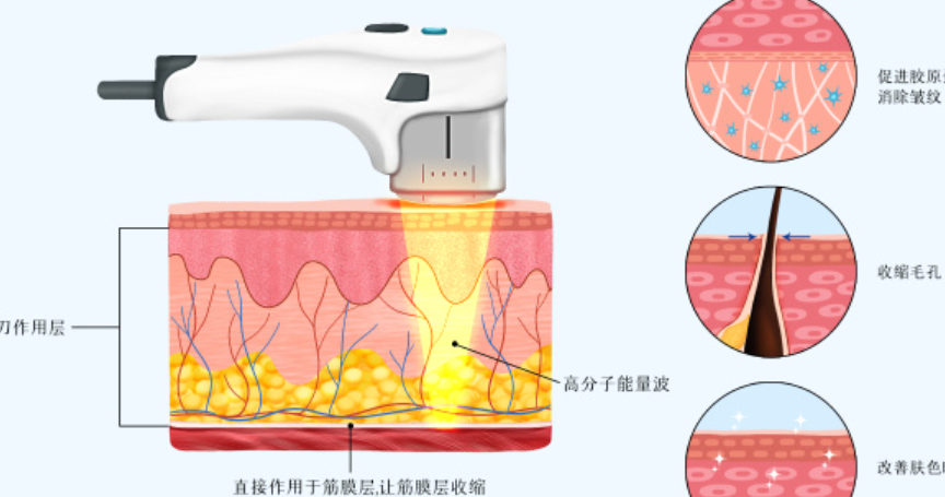 超声炮400刀8000发够吗？轻度松弛完全够用