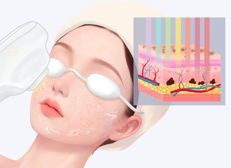 aopt超光子多少钱一次？基础护理约5500元，痤疮修复6200元，抗衰项目高达8800元