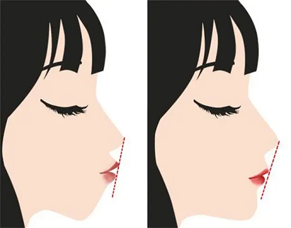 北口李自力做正颌技术怎么样？术后满意度达95%口碑爆棚！