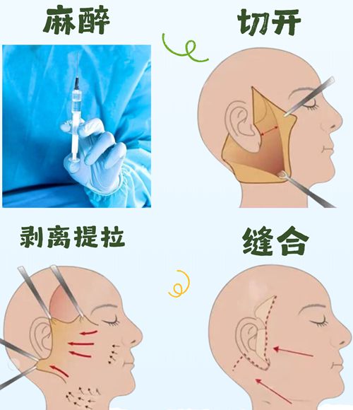 刘天一拉皮手术多少钱？上海华东医院68759元起，效果自然紧致无痕！