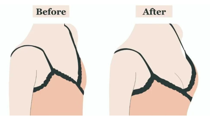 北京曹卫华做隆胸价格揭秘：自体脂肪25000起假体30000起效果自然不割韭菜