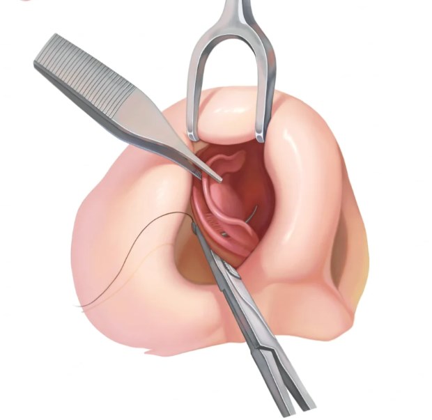 菲林普利隆鼻打在什么层？2026年鼻基底+鼻背层填充价格和效果对比揭秘！