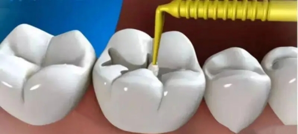 高端进口补牙材料有哪几种？复合树脂陶瓷玻璃离子三大类解析+价格参考揭秘！