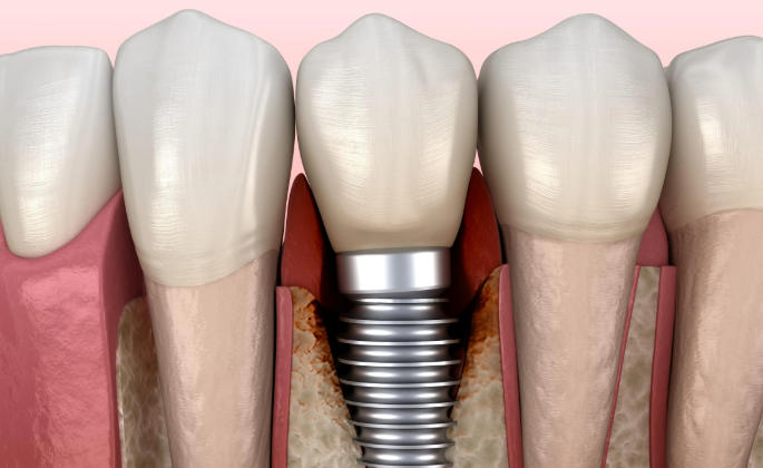 iti士卓曼骨水平怎么选？骨水平修复基台型号全解析，2026年价格揭秘！