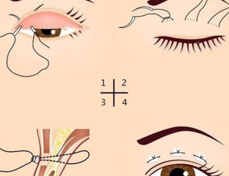 郑州双眼皮医生杨智勇做自然款双眼皮怎么样？微创技术+筋膜固定术后不反弹，郑州圣熙