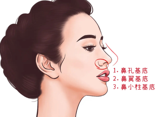 垫鼻基底前后对比照真实案例分享：法令纹改善明显+维持5年以上效果解析