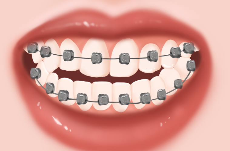 露龈笑手术贵吗？2026年价格揭秘：正畸和手术费用对比