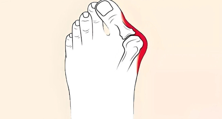 苏敬达拇外翻矫正手术微创技术如何？复发率低于3%术后2周穿凉鞋真靠谱！