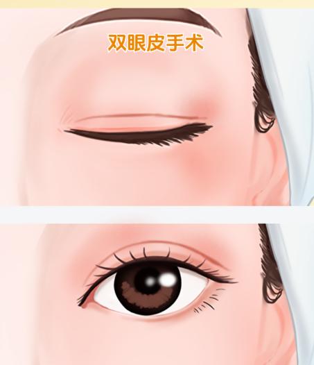 上海眼睛修复杜圆圆多少钱？4万-6万起，显微级操作+动态肌力平衡术成功率高	