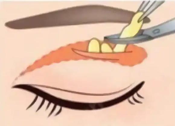 二、上海眼睛修复杜圆圆多少钱？价格构成与性价比分析