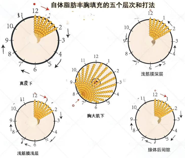 三、武汉隆胸项目价格参考与选择建议