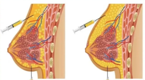 二、武汉隆胸实力医院医生技术特点与实例分析
