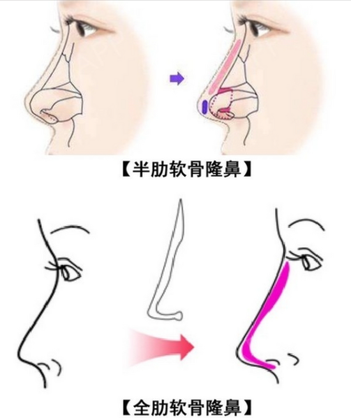 四、段焘肋骨隆鼻的价格构成与性价比