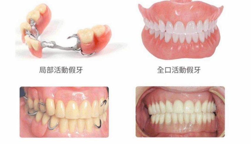 吸附性义齿制作全过程完整版：2026年数据统计显示成功率高达85%	