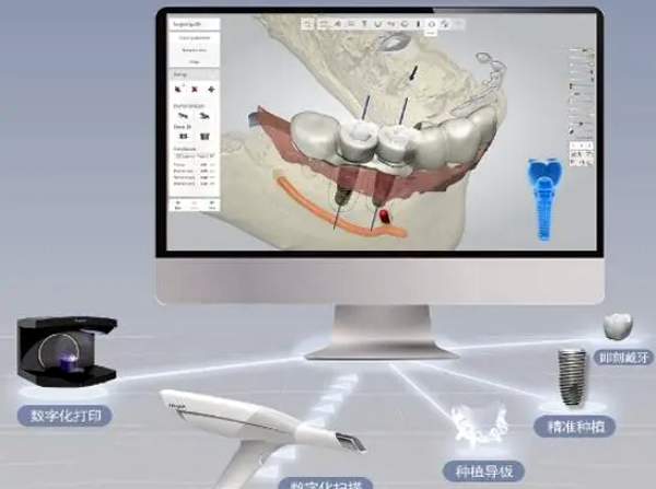 3d导板数字化种植牙靠谱吗？95%用户反馈技术精准，30分钟完成手术更省心	