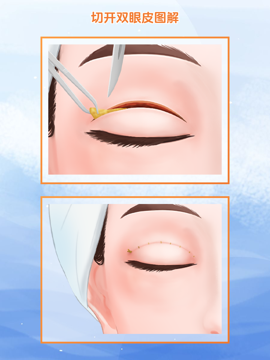 杭州双眼皮医生推荐及价格全解析！徐丹盛飞等修复专家15000元起比埋线更值	