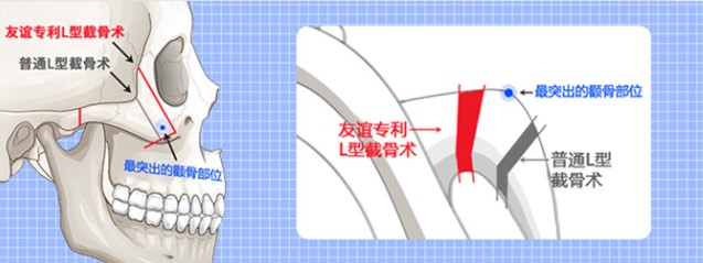 二、黄大勇磨骨技术是否值得信赖？