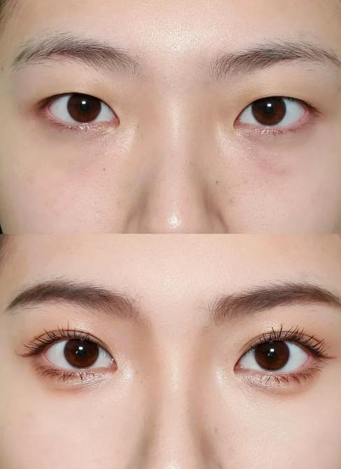 五、合肥曹林双眼皮靠谱吗？选择建议与避坑指南