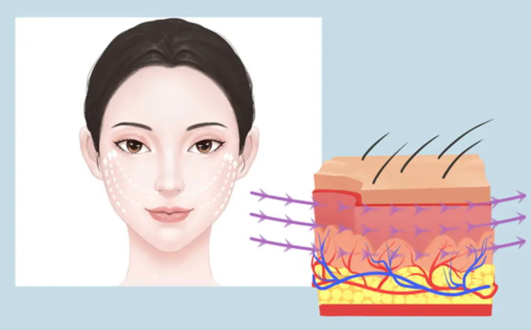 二、颧弓收窄的好处｜提升面部立体感的医学机制