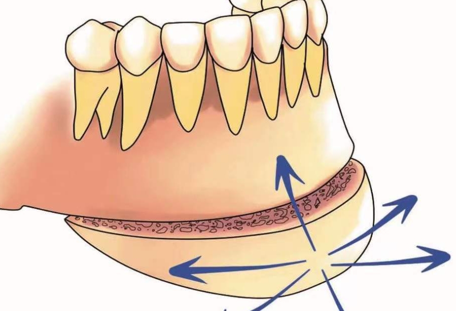 下巴截骨后移矫正效果怎么样？真实案例对比+术后3个月恢复期全解析！	